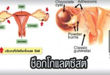 ศิริราชให้ความรู้ประชาชน “โรคช็อกโกแลตซิสต์”