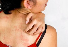 เข้าสู่ “ฤดูร้อน” เต็มตัวเตรียมรับมือ”8 โรคผิวหนัง”